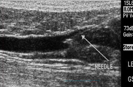Ultrasound scan with an arrow labeled “NEEDLE” pointing to a needle insertion site.