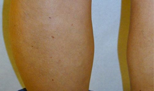Close-up of two bare legs with a visible darkened patch on the left calf