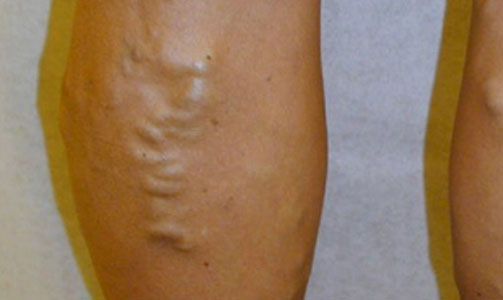 Close-up of a leg showing varicose veins and bulging skin against a plain background