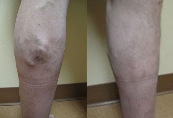 Close-up of two lower legs, one showing a bruised, swollen knee.