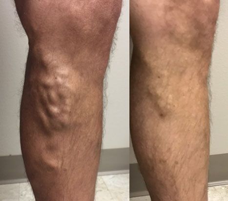Close-up of a calf with visible varicose veins, shown from two angles against a plain indoor background.