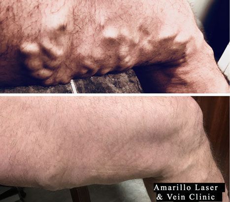 Before-and-after close-up of a forearm with raised veins, showing treatment results.