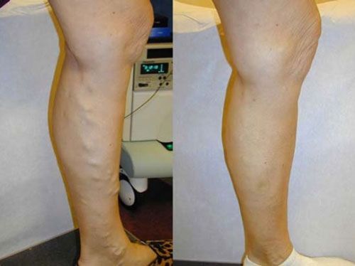 Side-by-side lower legs showing a calf before-and-after comparison against a clinic background