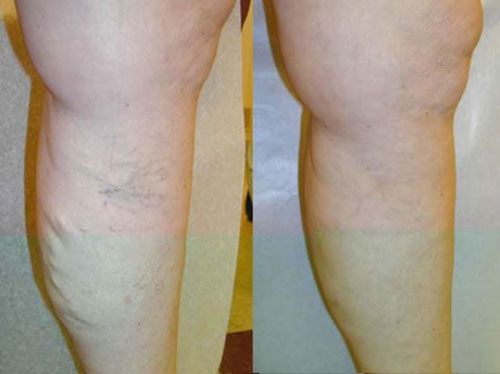 Side-by-side close-up of lower legs showing a white tan line around the calves and ankles