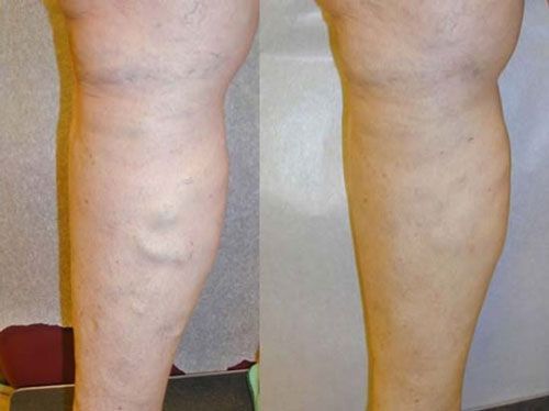 Side-by-side lower leg photos showing visible varicose veins on the left and a smoother leg on the right