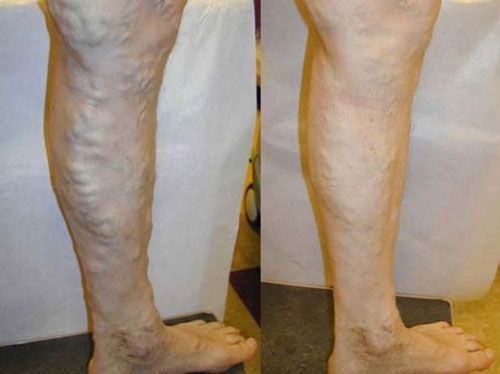 Side-by-side lower legs showing varicose veins and skin discoloration, before and after comparison