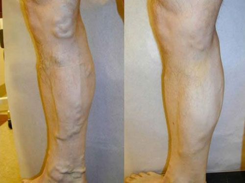 Side-by-side photos of a lower leg showing bulging varicose veins and smoother leg profile.