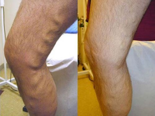 Close-up of a leg showing two side-by-side views with visible swelling and skin discoloration