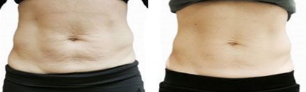 Before and after pictures of Venus Versa treatment