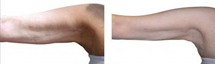 Before and after pictures of Venus Versa treatment - arms