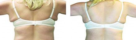 Before and after pictures of Venus Versa treatment - back