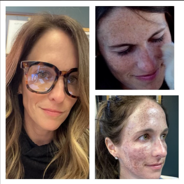 a woman wearing glasses is shown before and after a treatment