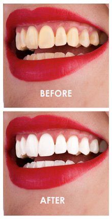 Before and after shots of teeth whitening process
