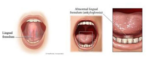 Lip Tie And Tongue Tie Breastfeeding Aitkin Mn