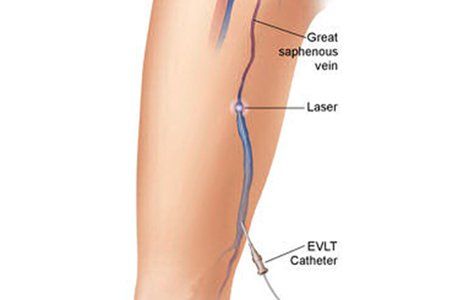 Endovenous Laser Therapy (EVLT)