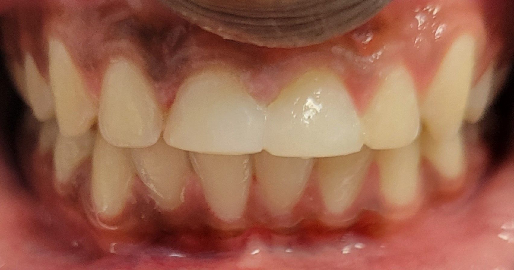 A close up of a person 's teeth and gums.