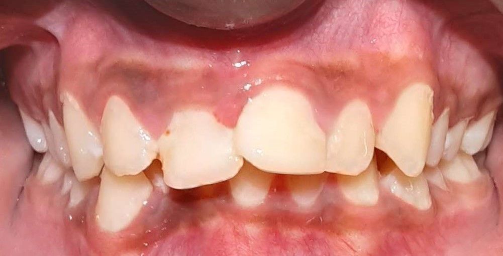 A close up of a person 's teeth and gums.