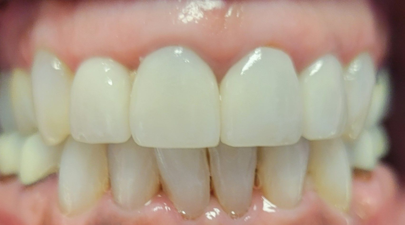 Elizabeth anterior crowns before
