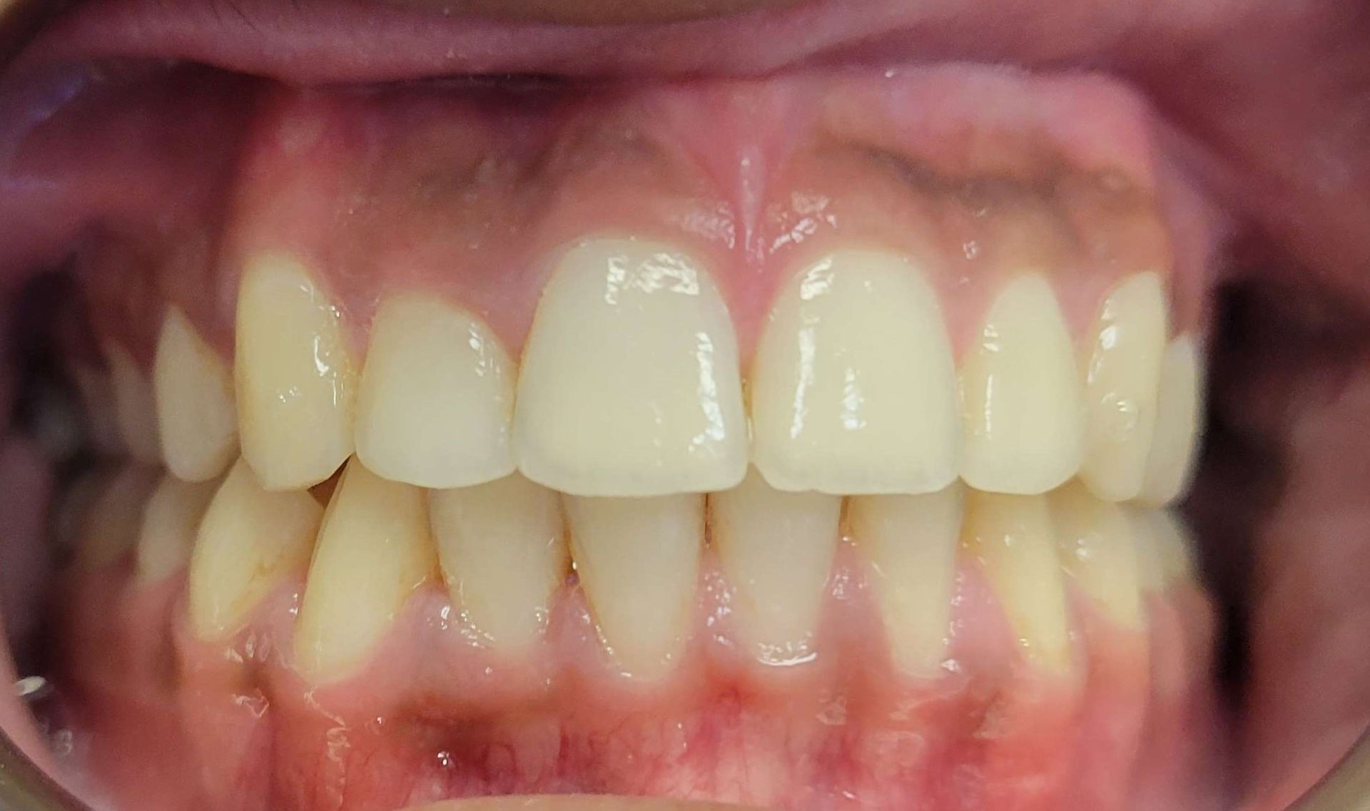 Orthodontic Treatment Fenil Teeth - After