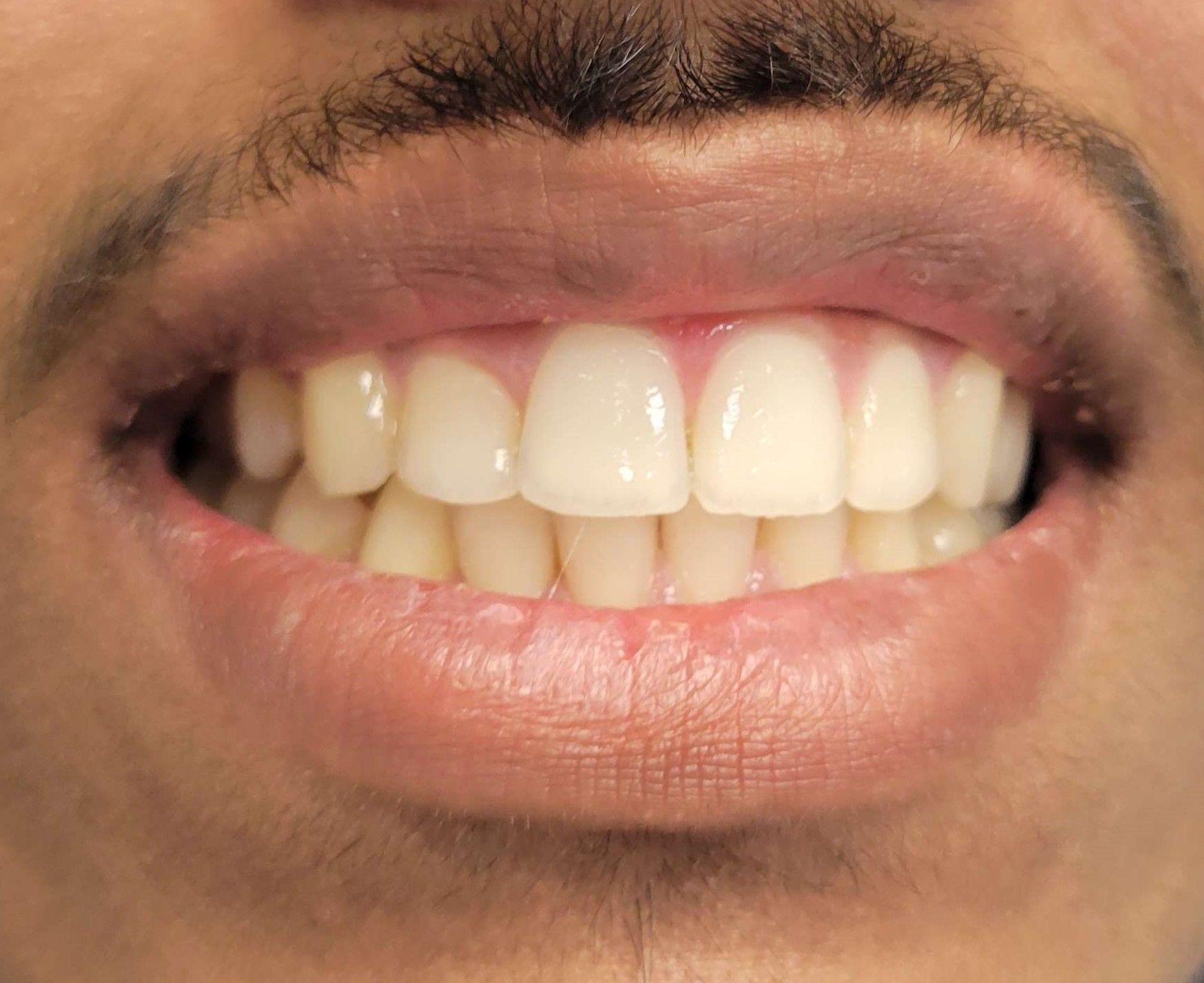 Orthodontic Treatment Fenil Smile - After