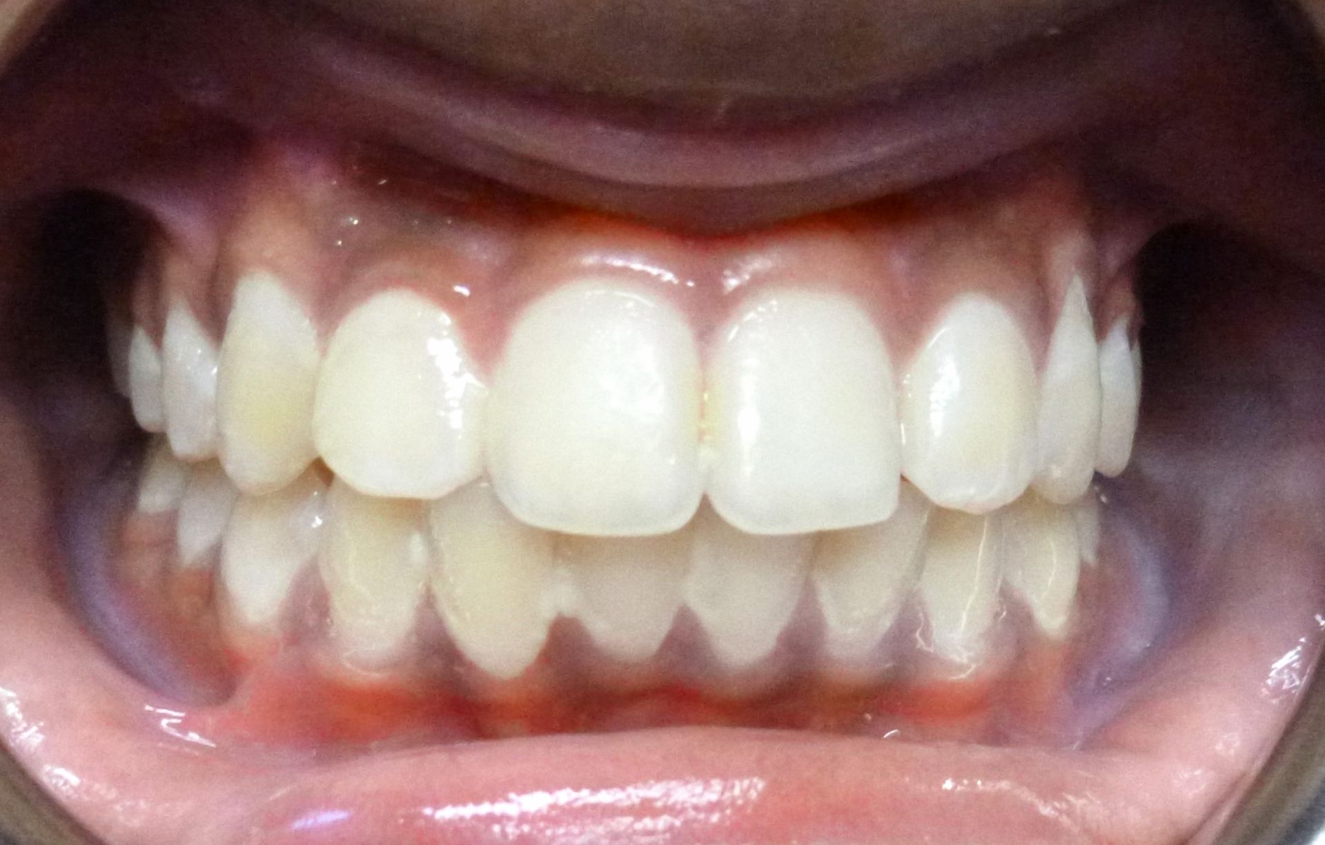 Orthodontic Treatment Nikhil - After