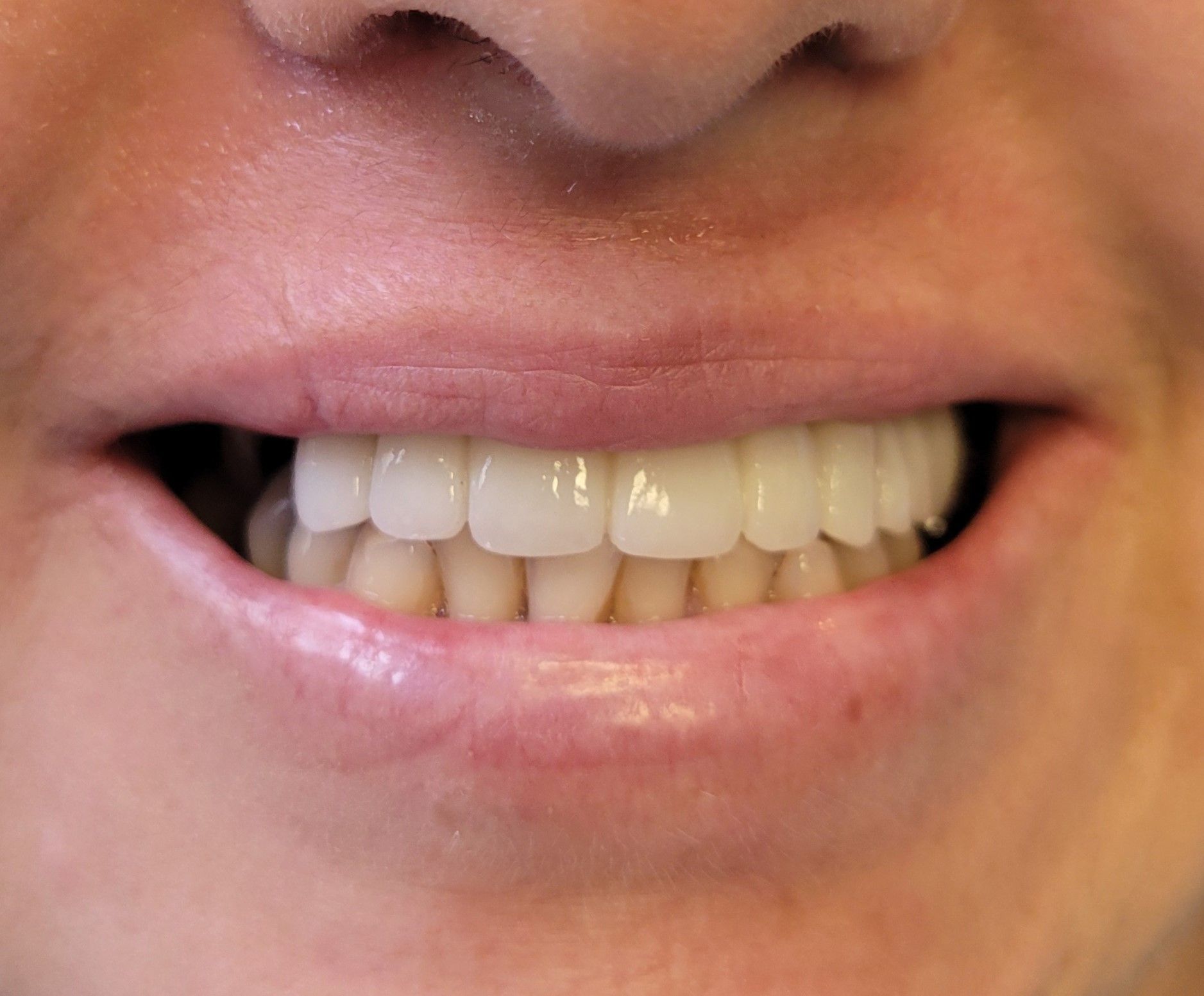 Anterior Bridge and Crown Gladis - After