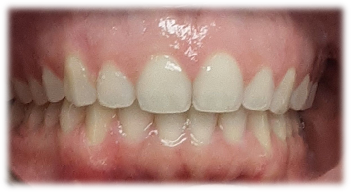 Invisalign - After