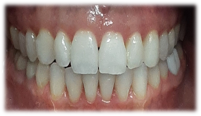 Invisalign - After