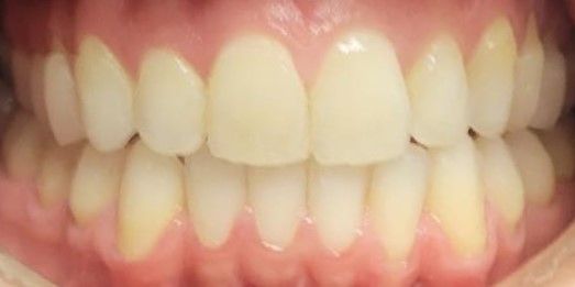 Beau Invisalign after
