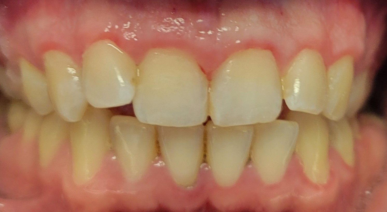 Anterior Composite Restoration - after