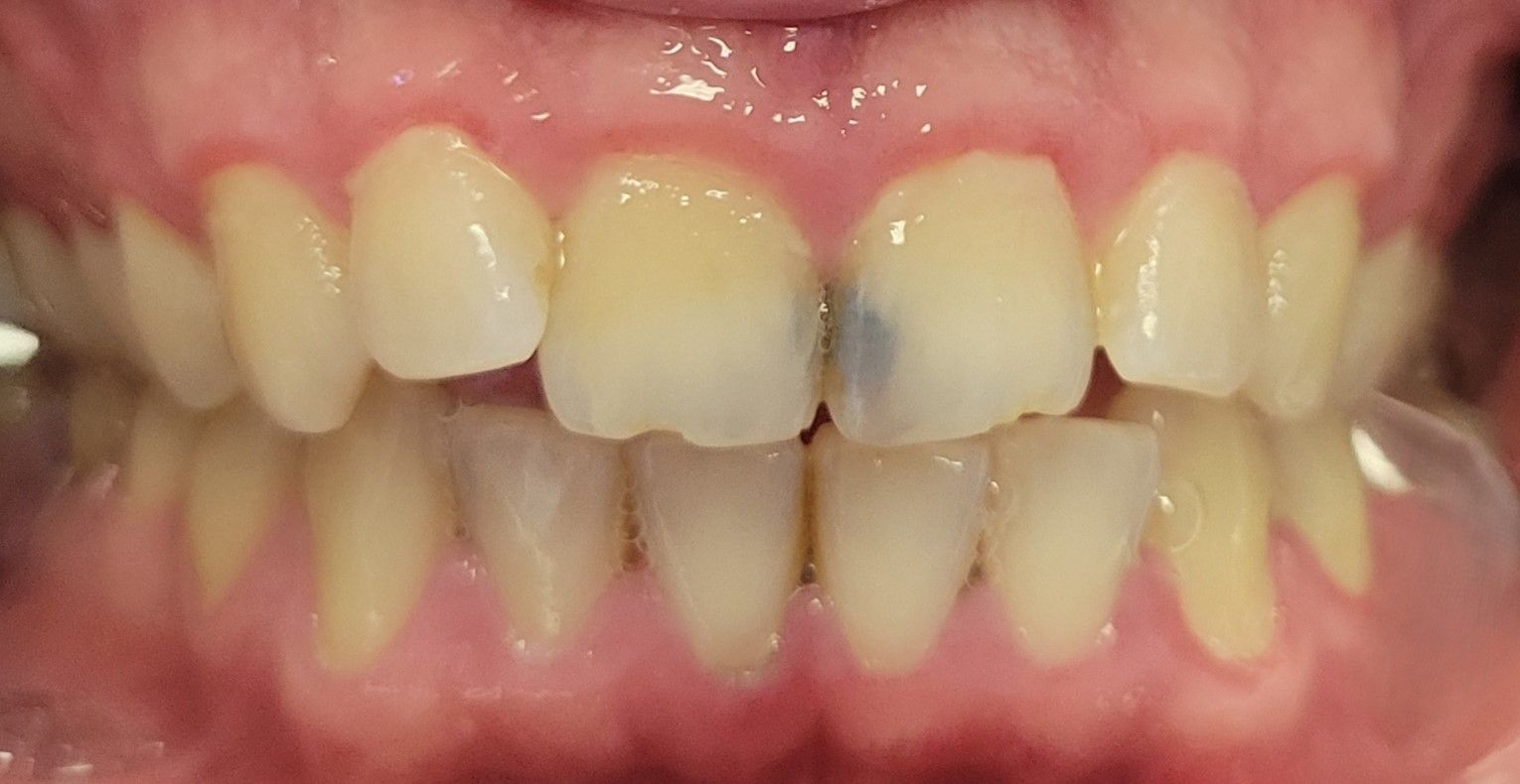 Anterior Composite Restoration - before
