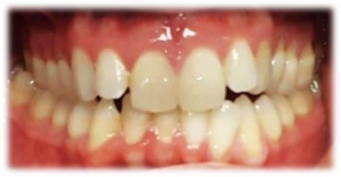 Beau Invisalign before