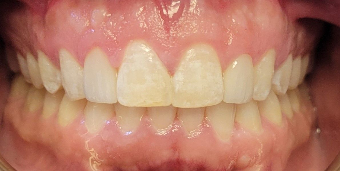 Cameron after veneer treatment