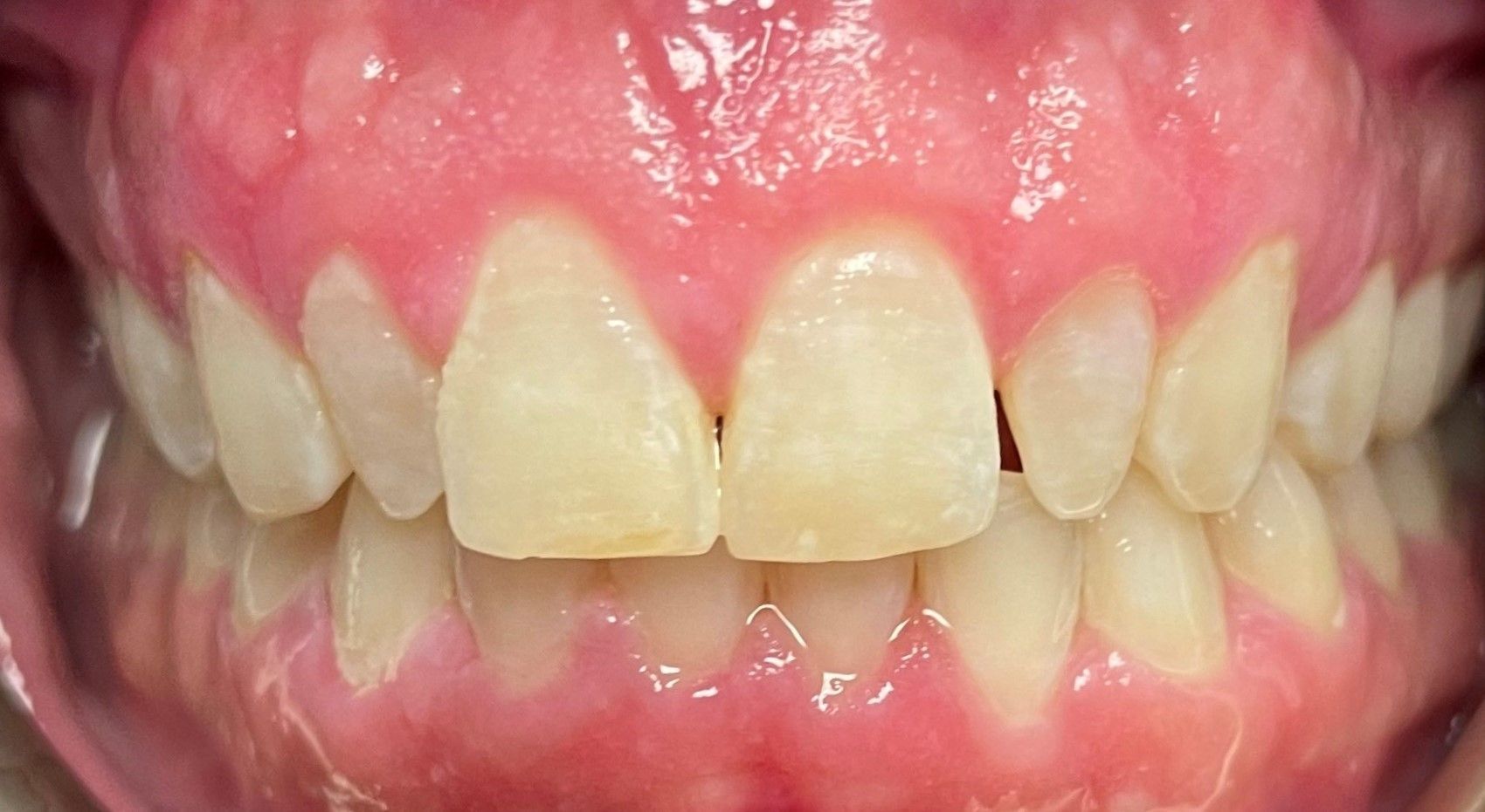 Cameron before veneer treatment