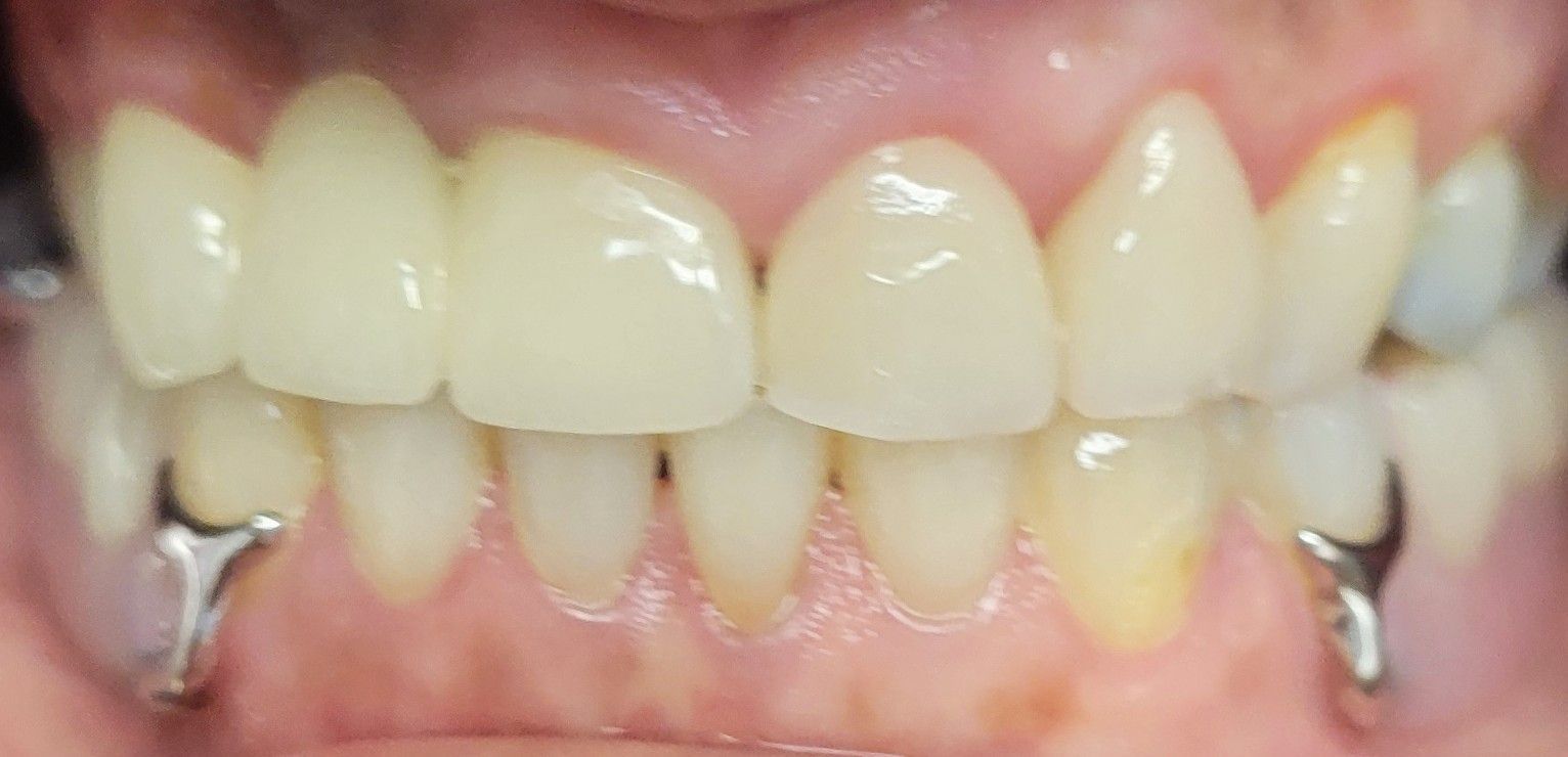 Elizabeth anterior crowns after