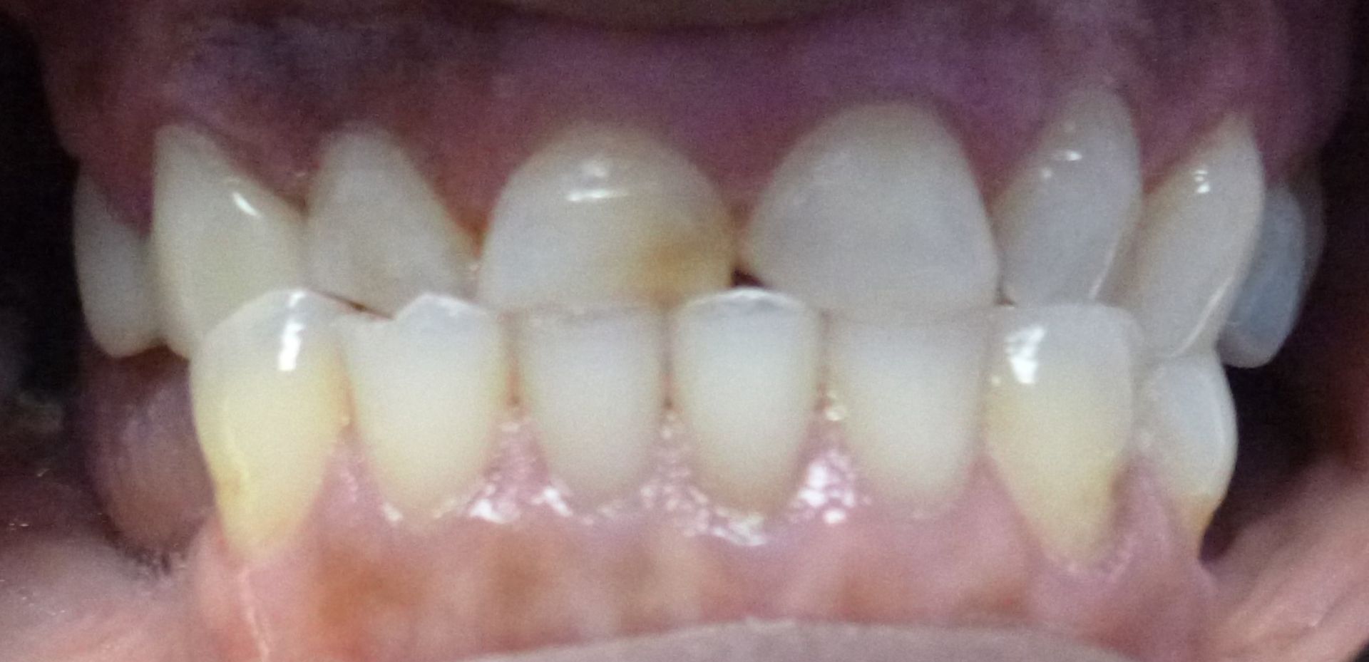 Elizabeth anterior crowns before