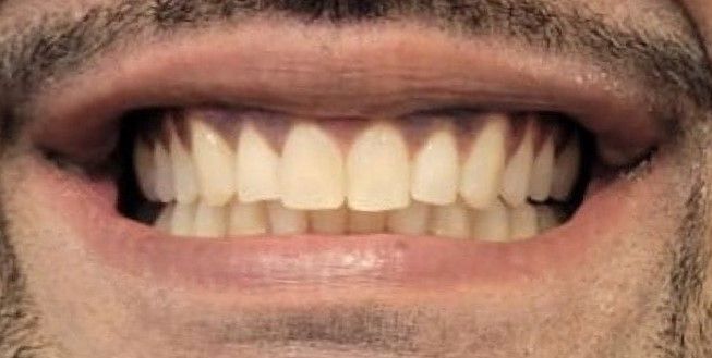 Patient Invisalign after