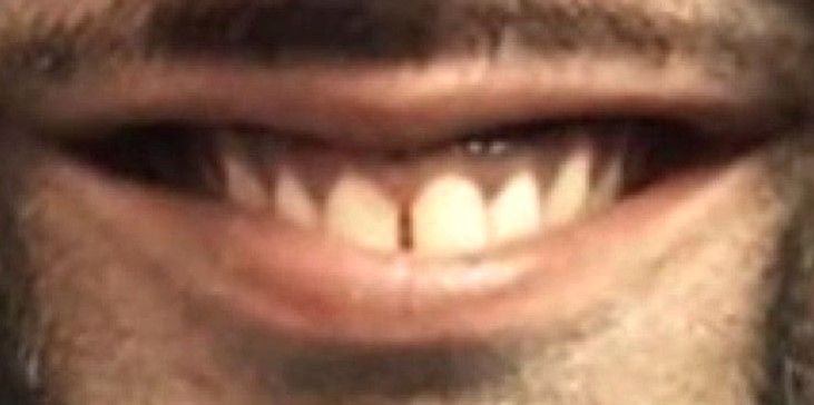 Patient Invisalign before