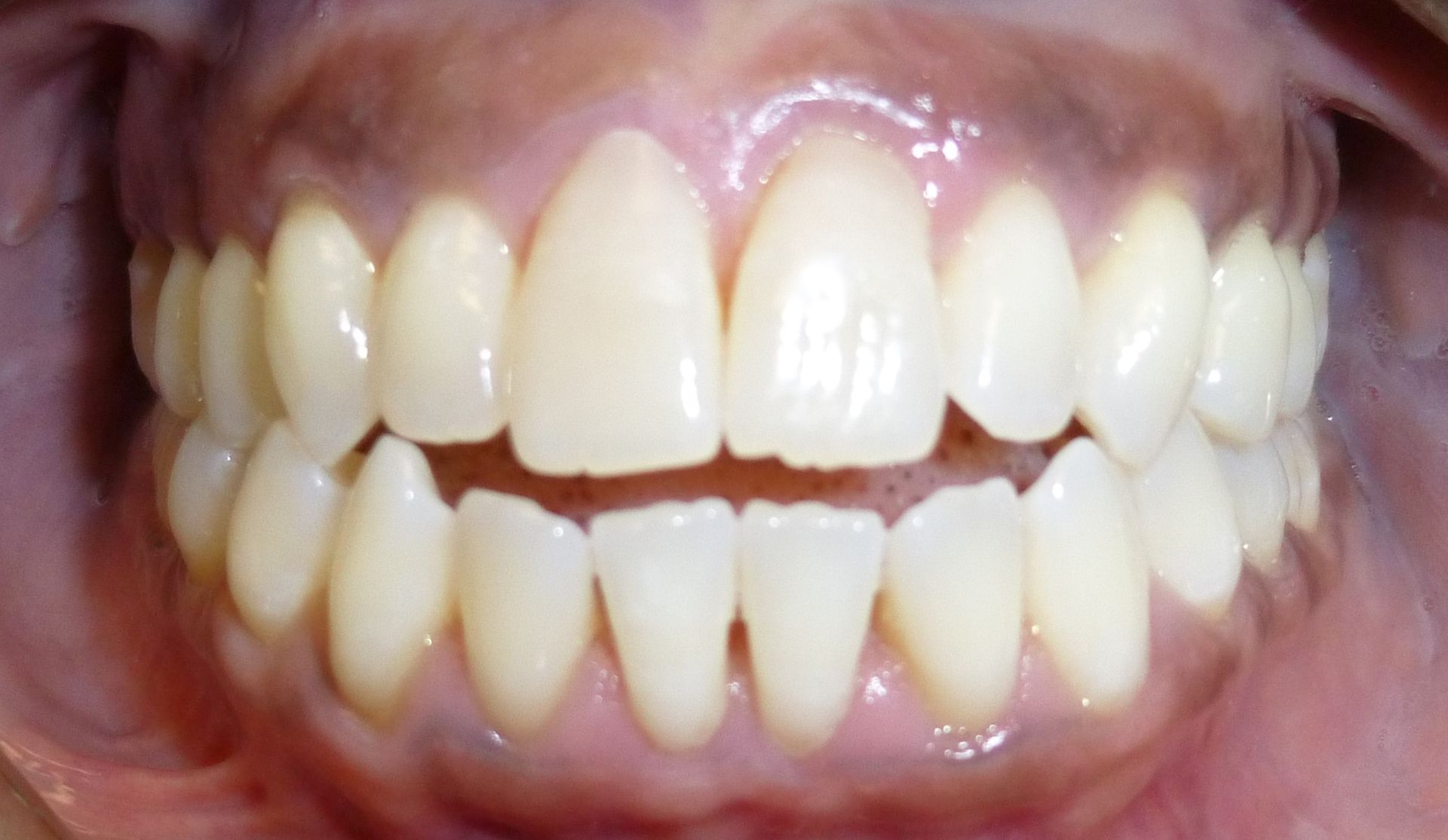 Orthodontic Treatment Alysia Teeth - Before