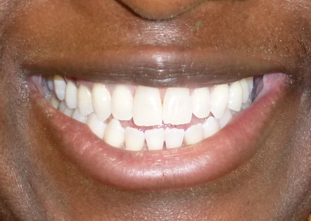 Orthodontic Treatment Alysia Smile - Before