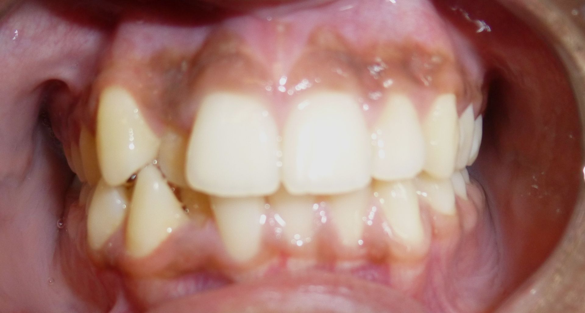 Orthodontic Treatment Fenil Teeth - Before