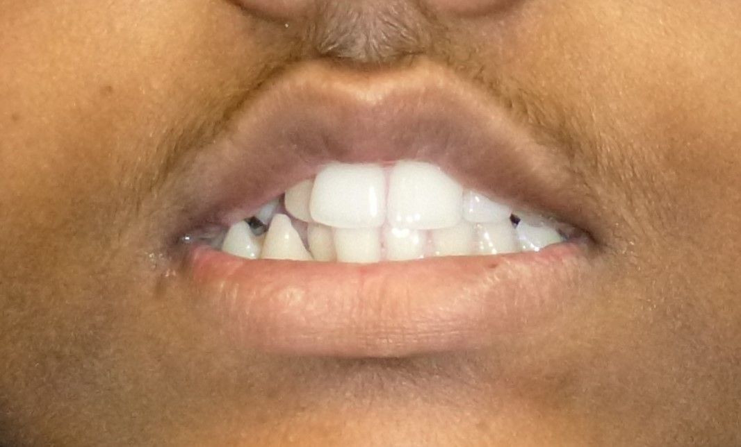 Orthodontic Treatment Fenil Smile - Before