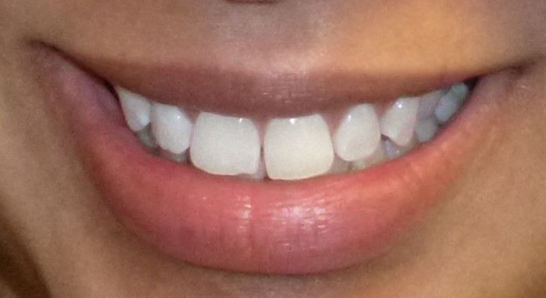 Orthodontic Treatment Jazmin - Before