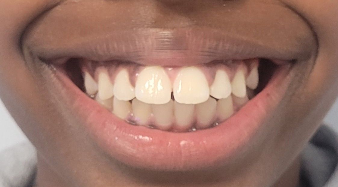 Orthodontic Treatment Deontae - Before