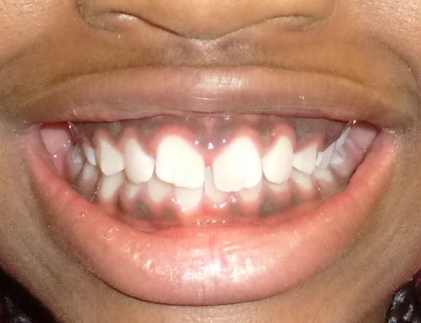 Orthodontic Treatment Jamaya - Before