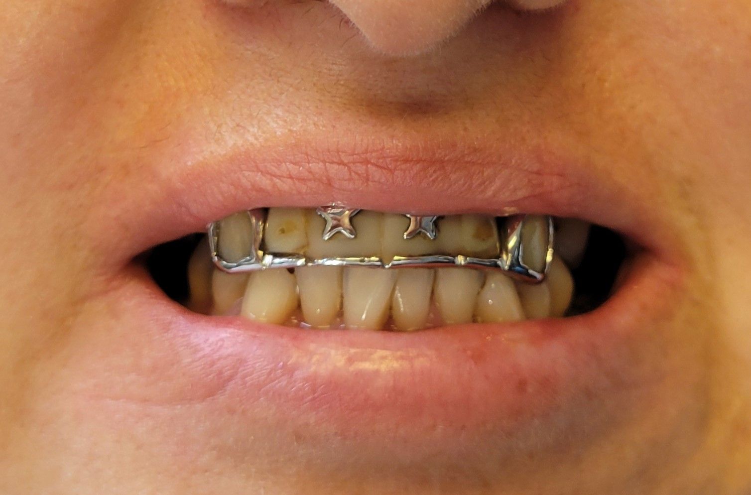 Anterior Bridge and Crown Gladis - Before