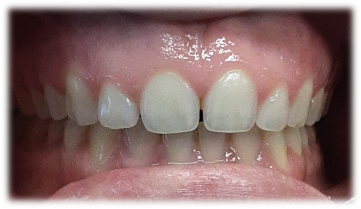 Invisalign - Before