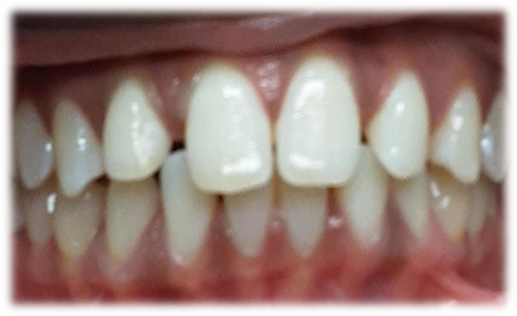 Invisalign - Before