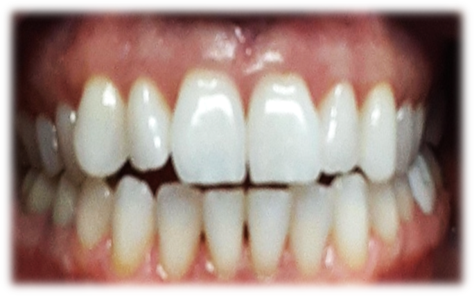 Invisalign - Before