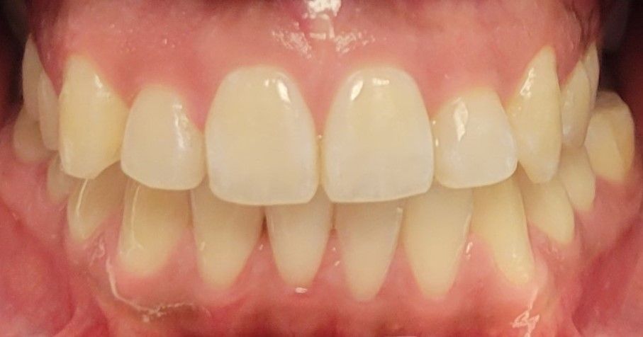 Close-up of a person's upper and lower teeth, showing a healthy smile with clean, white, and well-aligned teeth.